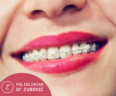 Poliklinikia Dr. Zubović: bon za fiksni zobni aparat