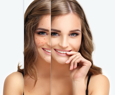 Beauty World by Tanja: microneedling, pomlajevanje