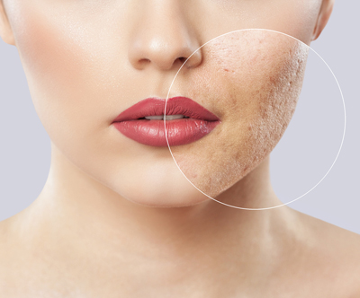 Društvo Vitus: pomlajevalni tretma microneedling