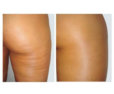Sense Wellness: anticelulitna terapija