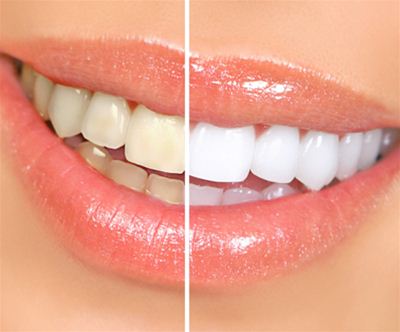 Beljenje zob, Zoom metoda