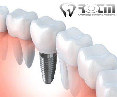 Vgradnja vrhunskega zobnega implantata