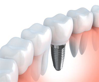 Vgradnja zobnega implantata