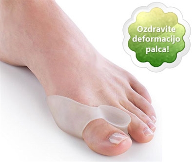 hallux valgus