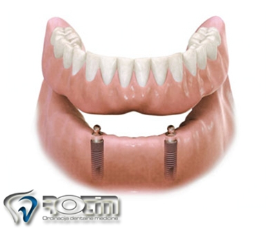 Izdelava vrhunske totalne zobne proteze + 2 implantata 