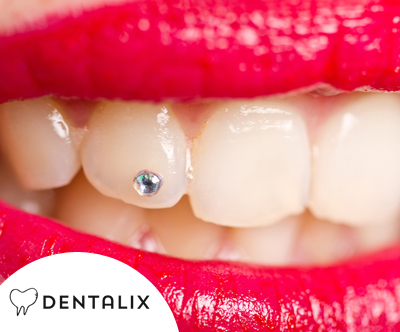 Dentalix; namestitev zobnega kristalčka