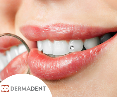 Dermadent: namestitev zobnega kristalčka