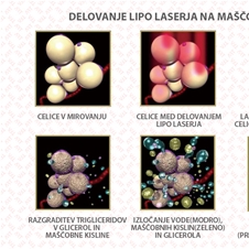Atelje Satin, preoblikovanje telesa z Lipo laserjem