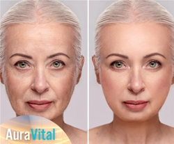 Studio AuraVital, radiofrekvenca obraza