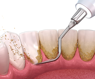 Zobozdravnica Tea: čiščenje zobnega kamna