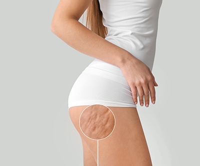 Terme Ptuj, wellness Valens Augusta: kavitacija