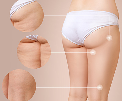 Terme Ptuj, wellness Valens Augusta: kavitacija