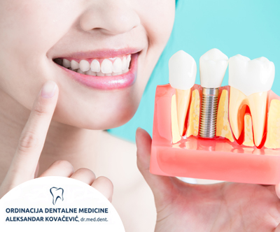 Ordinacija dr. med. dent. Aleksandar Kovačević: implant Ordinacija dr. med. dent. Aleksandar Kovačević: implant