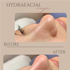 DS Beauty salon; Hydrafacial nega obraza z LED masko