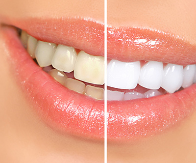 Cišcenje in beljenje zob