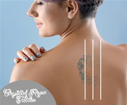 lasersko odstranjevanje tattoojev