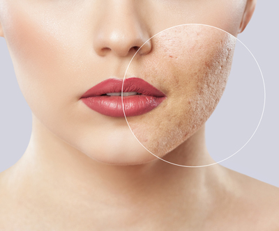 Vrhunski microneedling obraza in vratu (60 min)