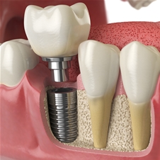 Ordinacija dr. med. dent. Aleksandar Kovačević: implant