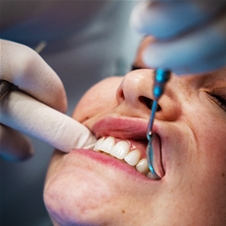 Dentpoint, čiščenje zobnega kamna